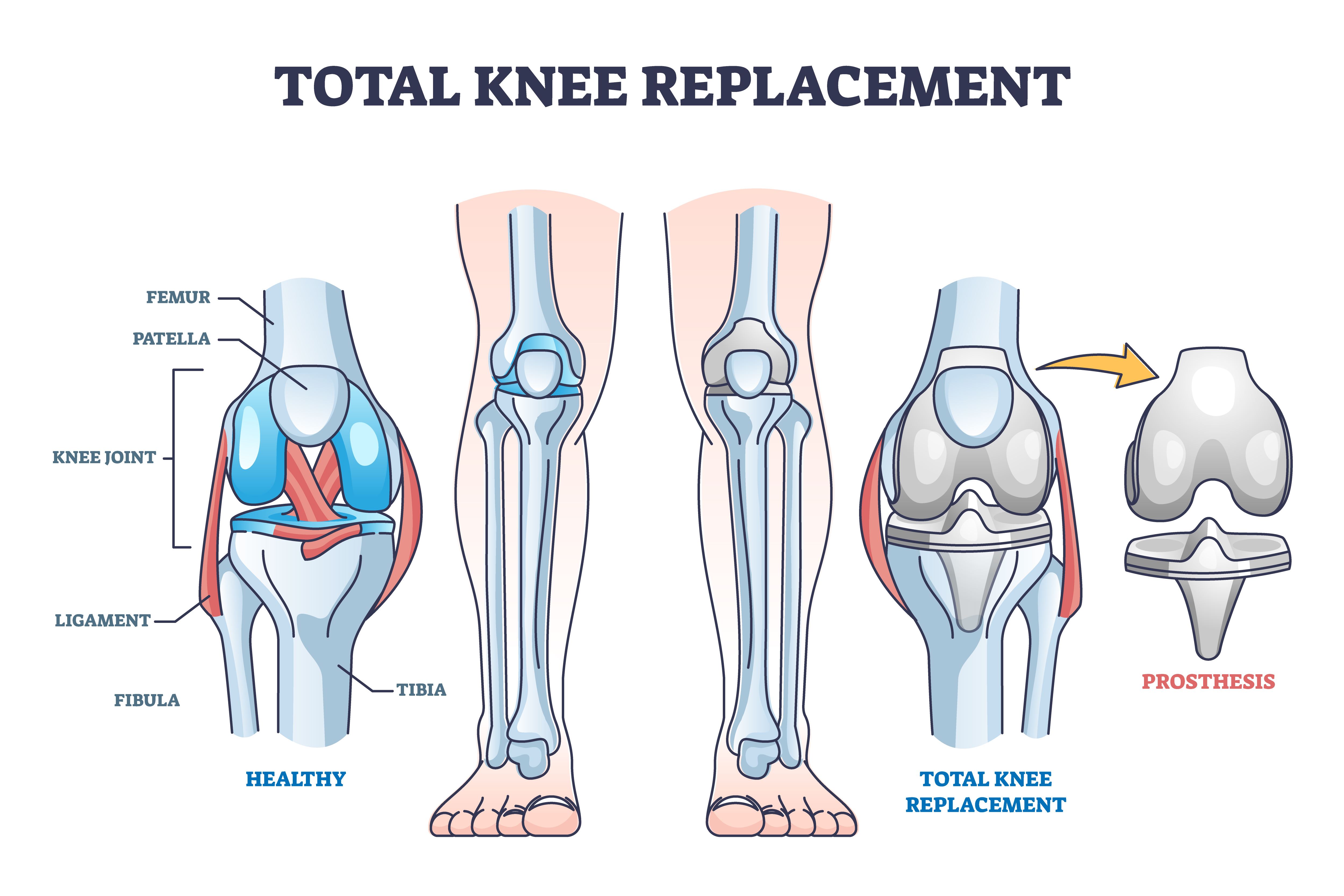Illustration of a total knee replacement