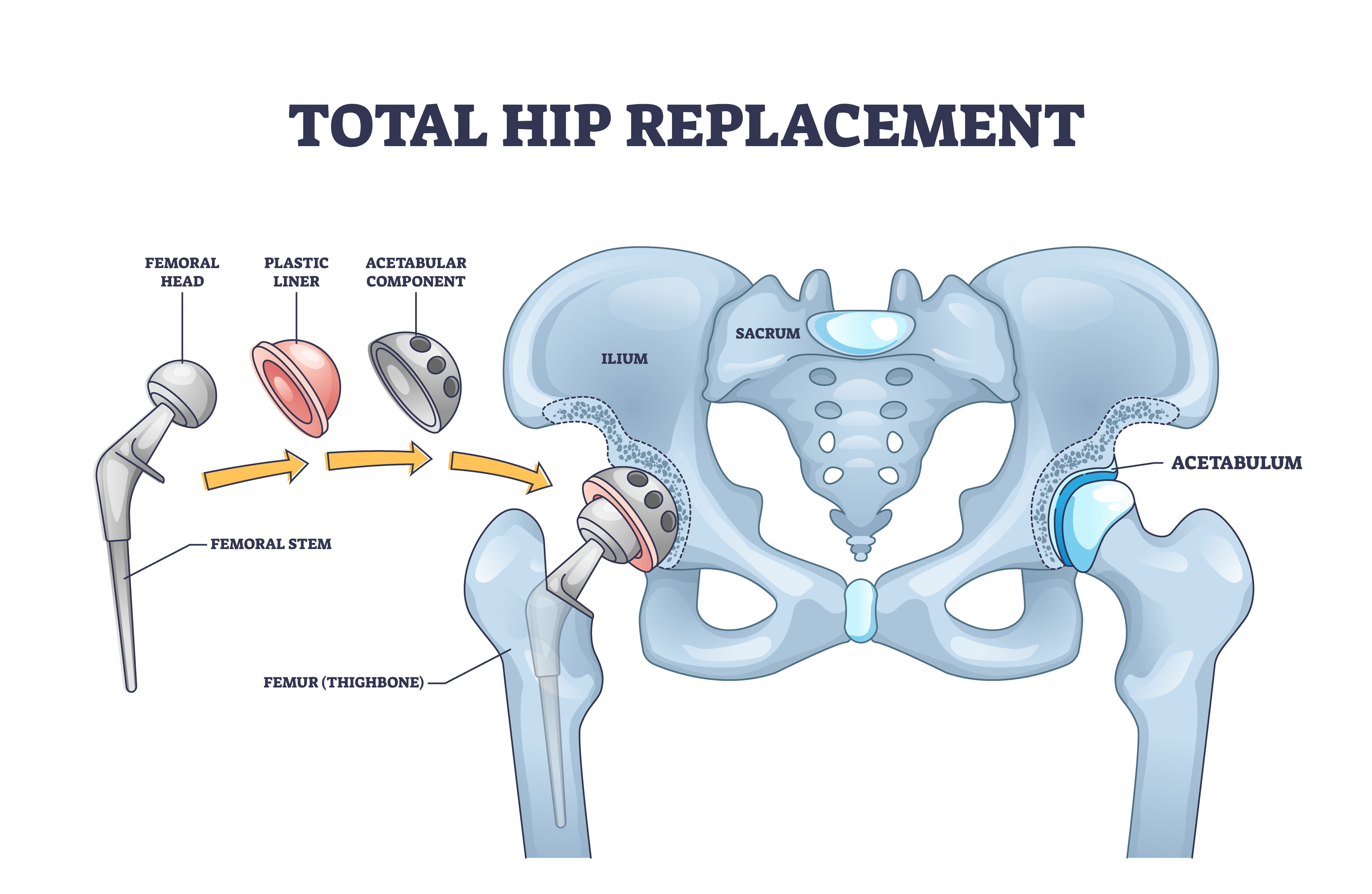 Illustration of a total hip replacement
